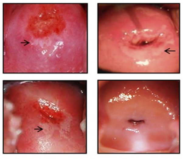 Динамика кольпоскопической картины до (справа) и после (слева) лечения трансфер-фактором цервицита, вызванного папилломавирусной инфекцией (по Acosta-Rios M.P. с соавт.)
